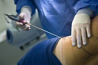 Liposuction Surgery Weight Loss